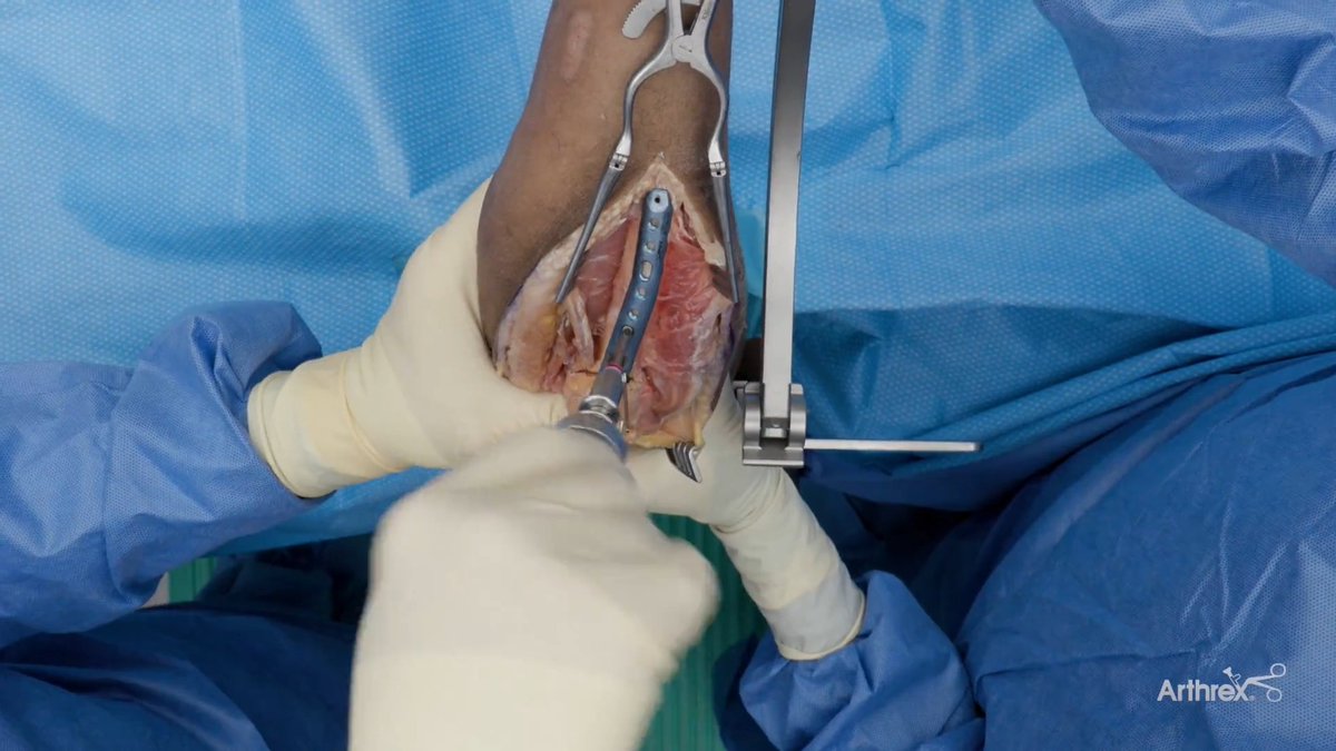 Lee Hunter, MD, presents the Arthrex Elbow Fracture Plating System, using a dorsal olecranon fracture plate to reduce the fracture. The elbow is positioned using the ElbowLoc® arm positioner, allowing the surgeon to complete the surgery in supine, as shown in this video, or lateral position. KreuLock™ locking compression screws allow for compression across the fracture and stability in the plate. Visit #Arthrex at Exhibit 409 during #OTA2026 to learn more about our latest innovations: #WhatsNewAtArthrex