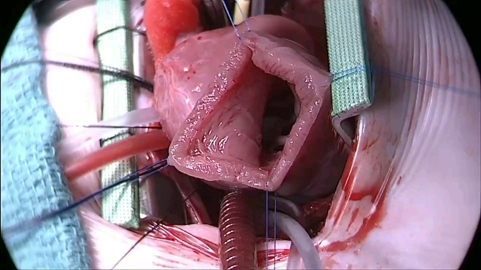 Have you ever seen Surgery For VSD (Hole in the Heart) Closure...? This is how it looks 🤯🤯 This video shows the clear view of Multiple VSD closure within a minutes via LV Apex Approach.