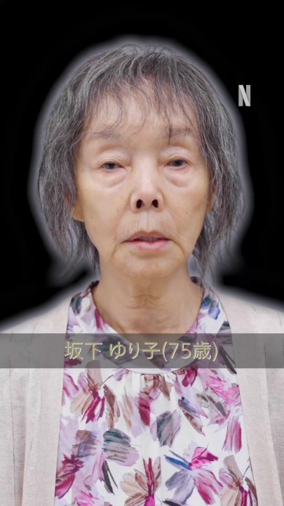 坂下ゆり子 (70代女性) BEFORE ▷ AFTER #ダウンタイム #ダウンタイム中 #ダウンタイムはネトフリ #ビフォーには戻れない #Plasticbeauty #downtime