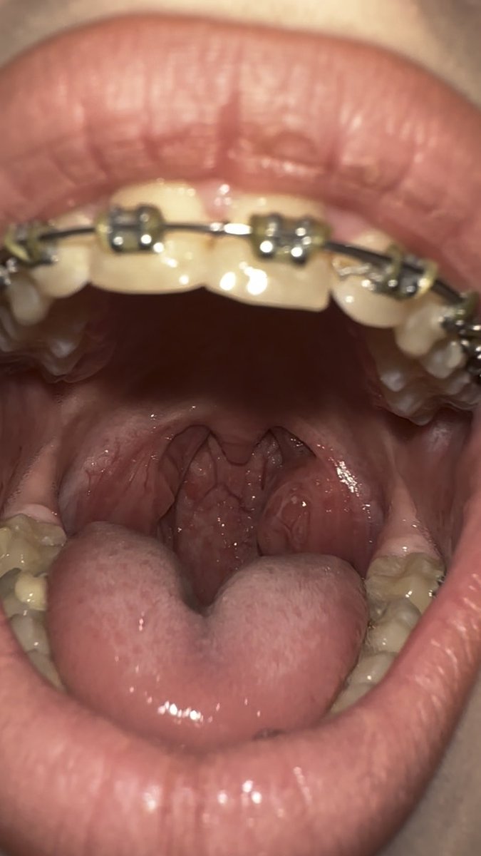 I love my big tonsils ) and you will love it too😏 #uvula #tonsils