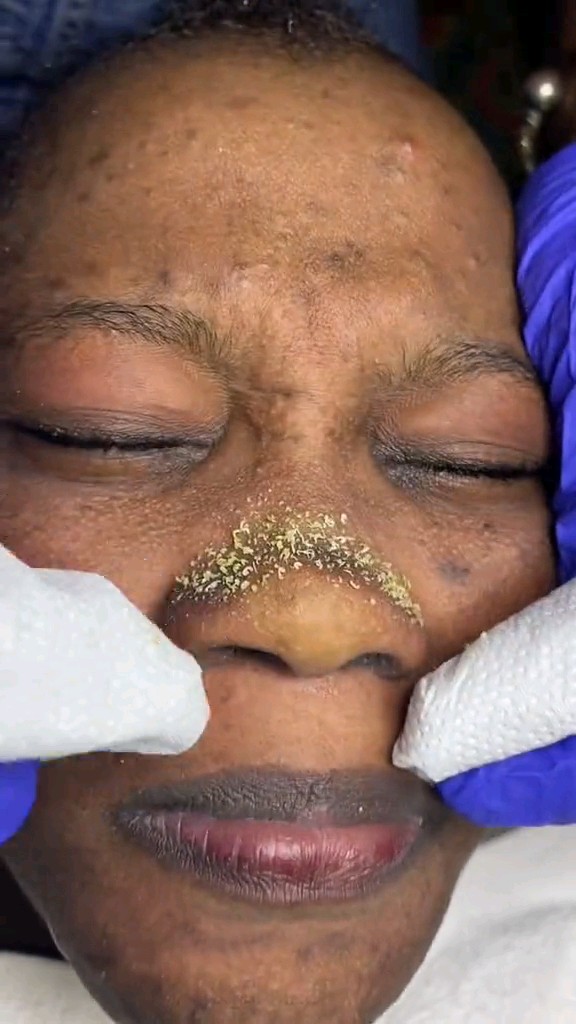 The blackhead buildup hiding inside those pores is finally getting the attention it deserves. Every successful blackhead extraction brings that deep clean feeling that makes it almost impossible to look away.